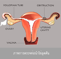 สาเหตุของคนมีลูกยาก